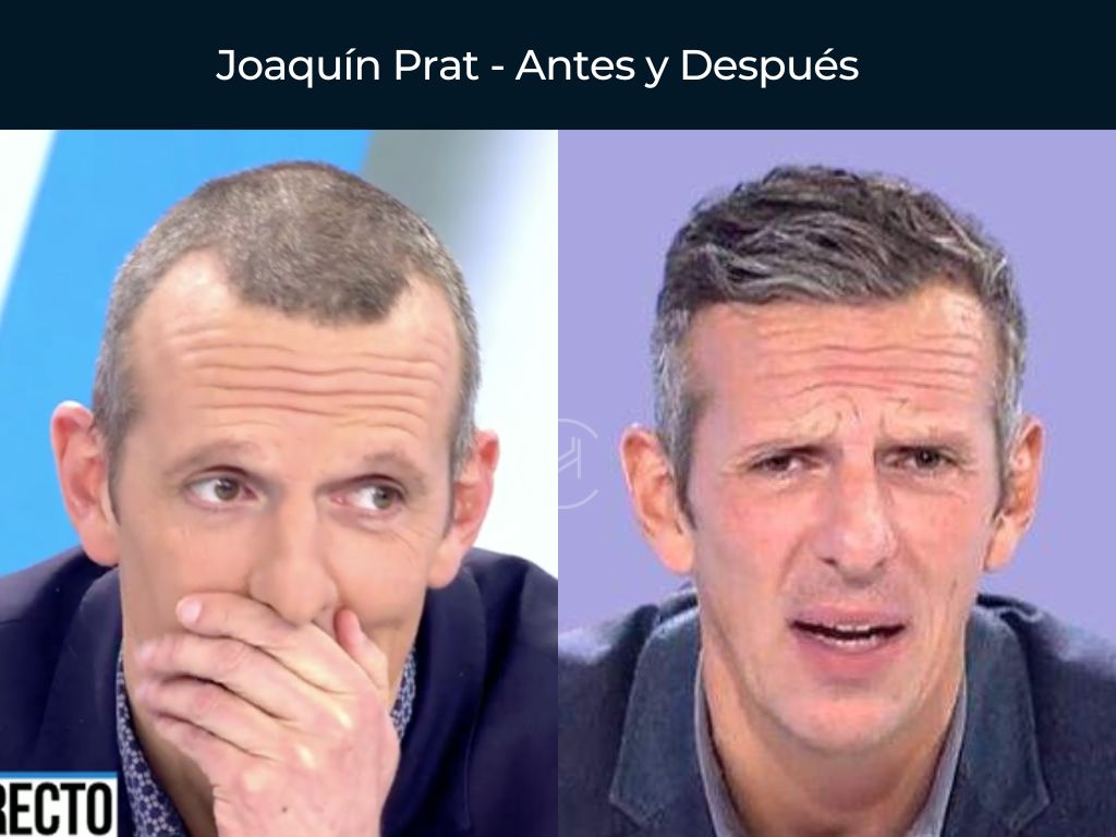 Joaquín Prat - Antes y Después Injerto Capilar