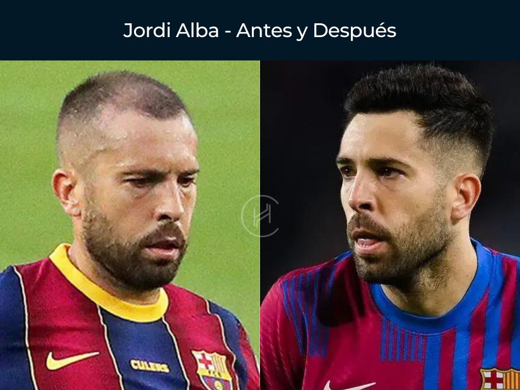 Jordi Alba - Antes y Después Injerto Capilar