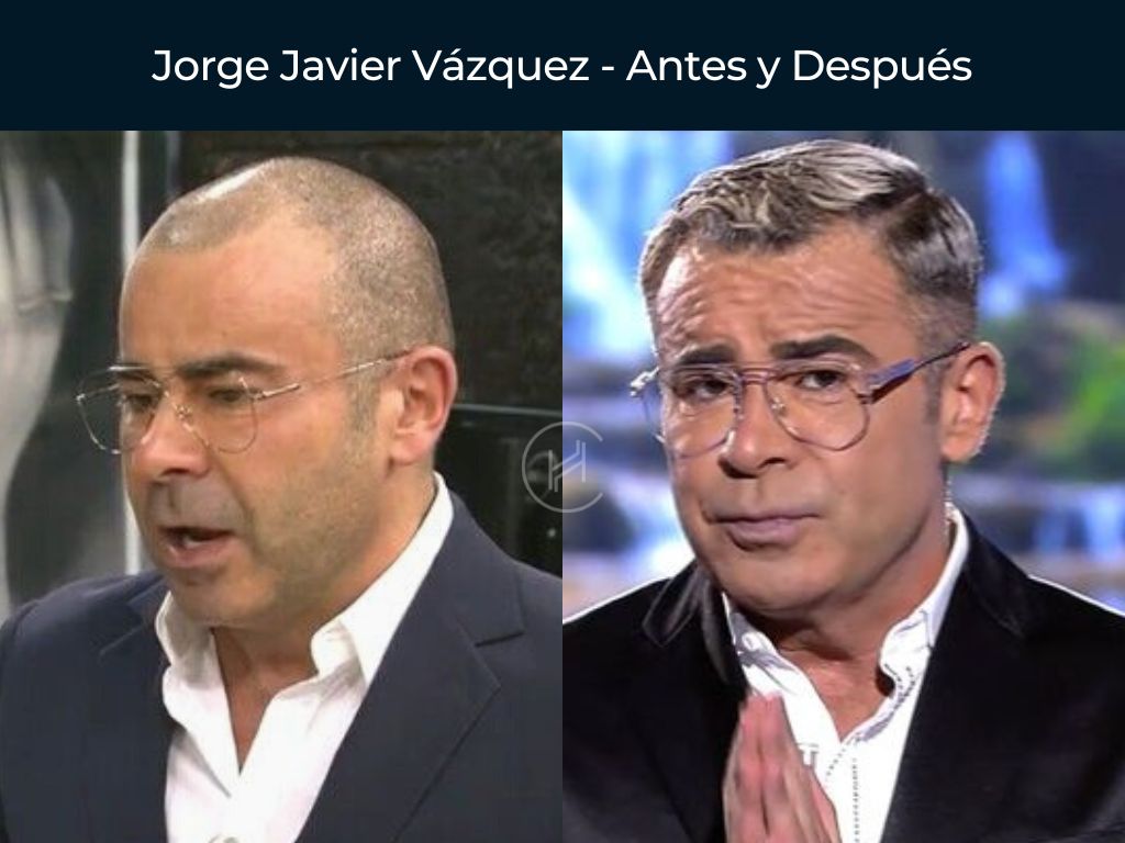 Jorge Javier Vázquez - Antes y Después Injerto Capilar