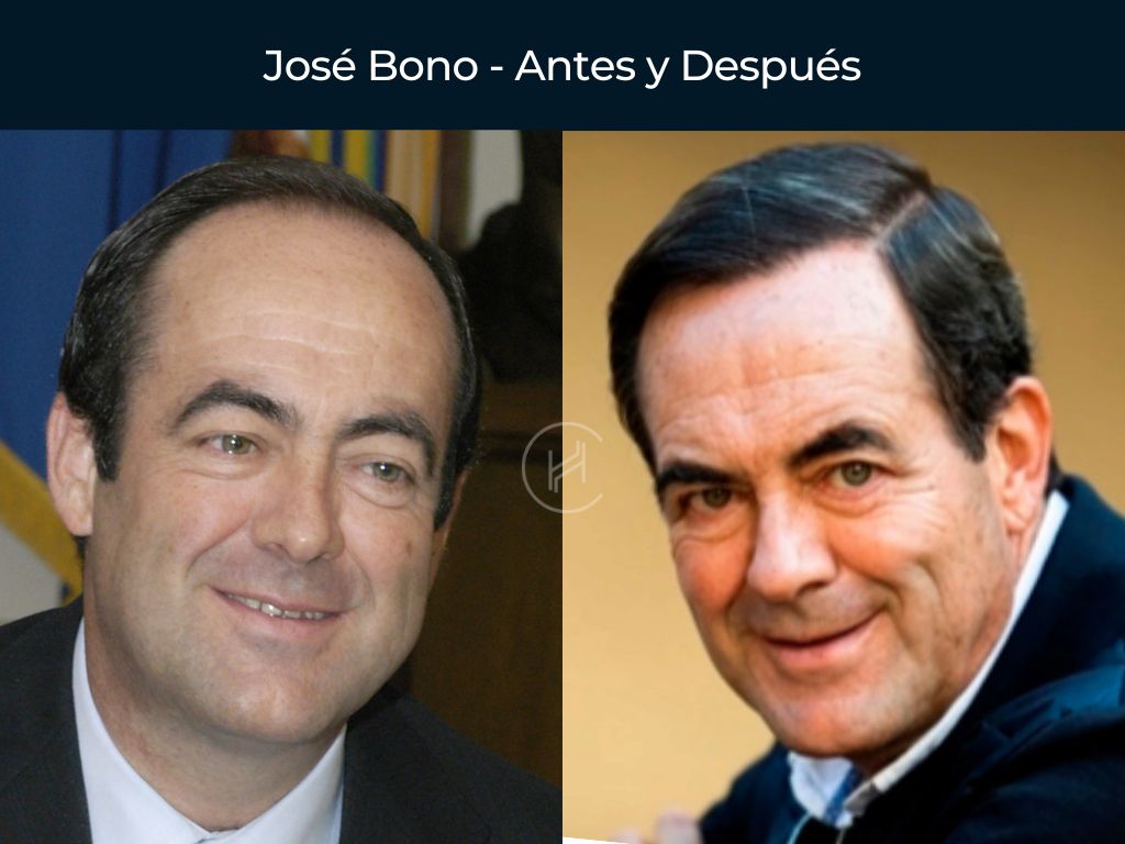 José Bono - Antes y Después Injerto Capilar