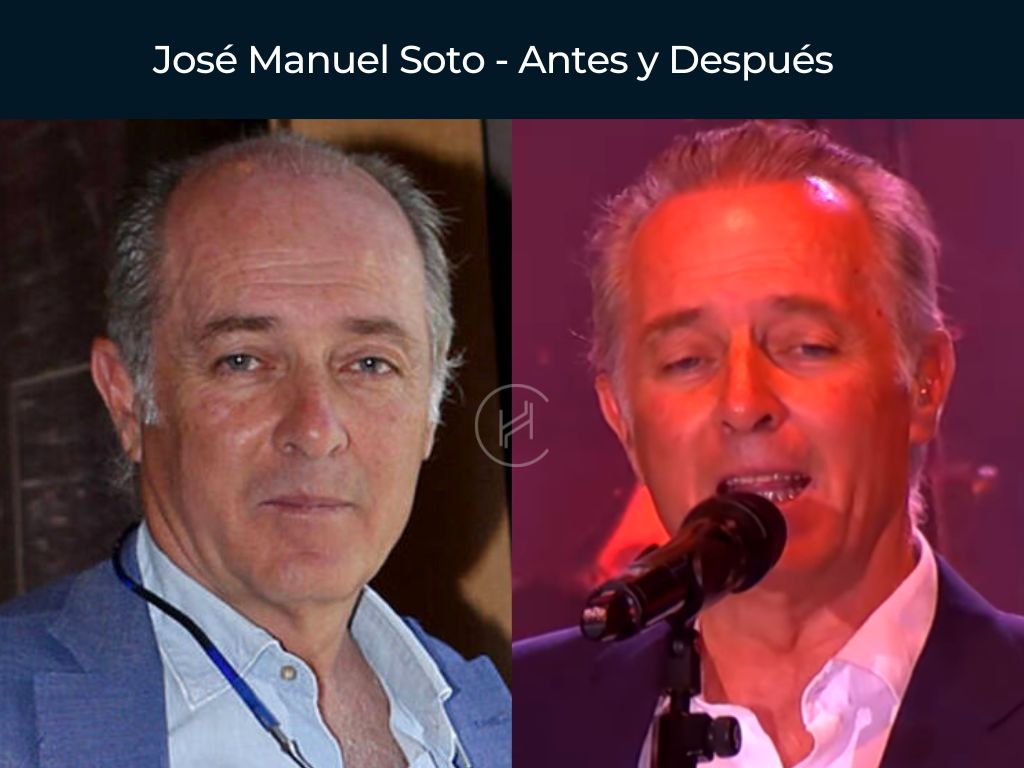 José Manuel Soto - Antes y Después Injerto Capilar