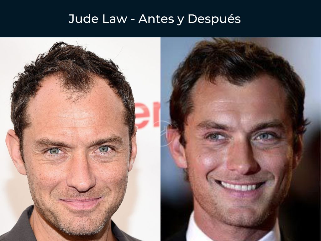 Jude Law - Antes y Después Injerto Capilar