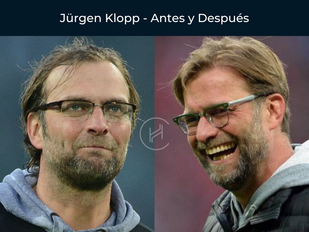 Jürgen Klopp - Antes y Después Injerto Capilar