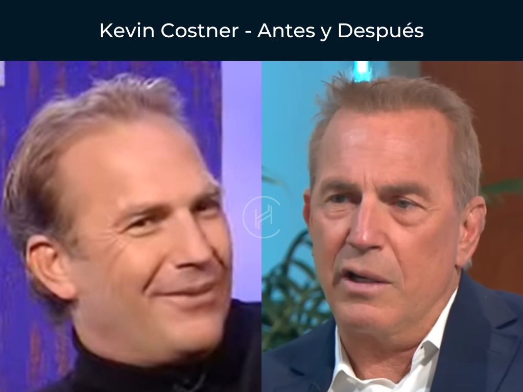Kevin Costner - Antes y Después Injerto Capilar