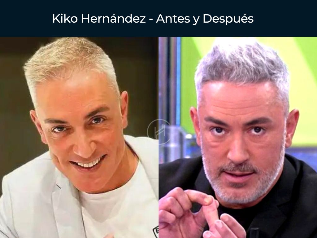 Kiko Hernández - Antes y Después Injerto Capilar