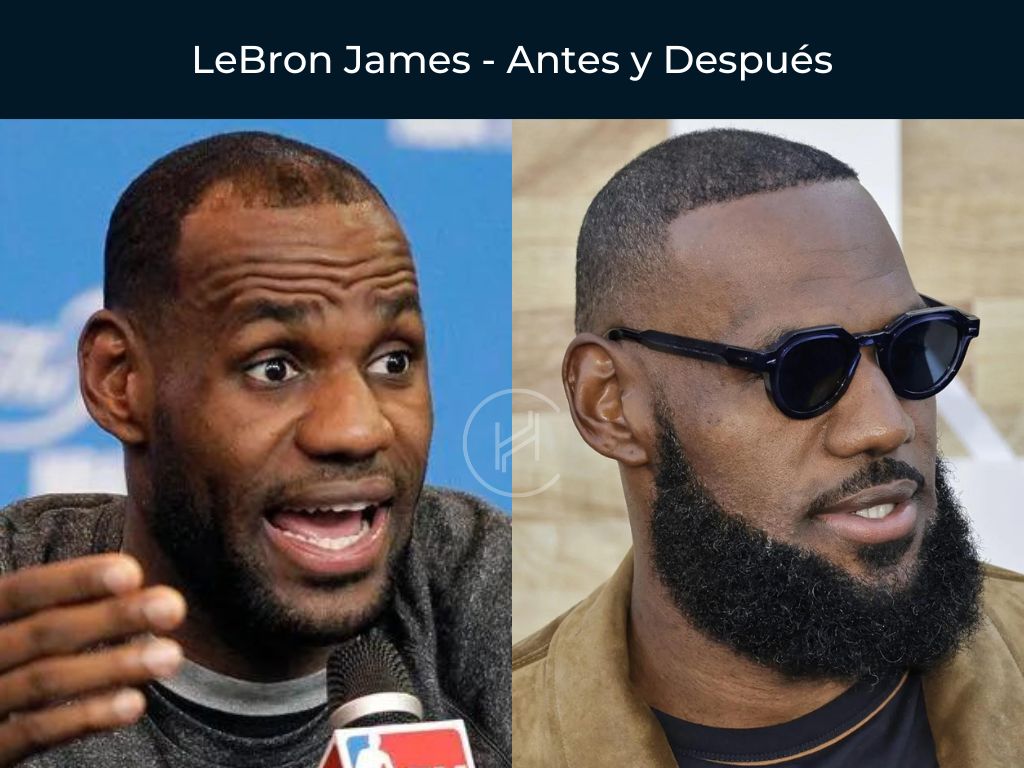 LeBron James - Antes y Después Injerto Capilar