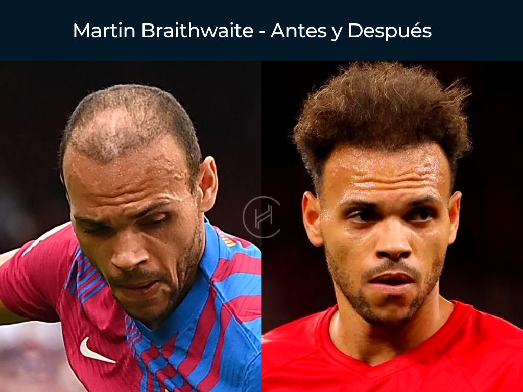 Martin Braithwaite - Antes y Después Injerto Capilar