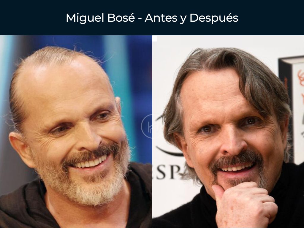 Miguel Bosé - Antes y Después Injerto Capilar