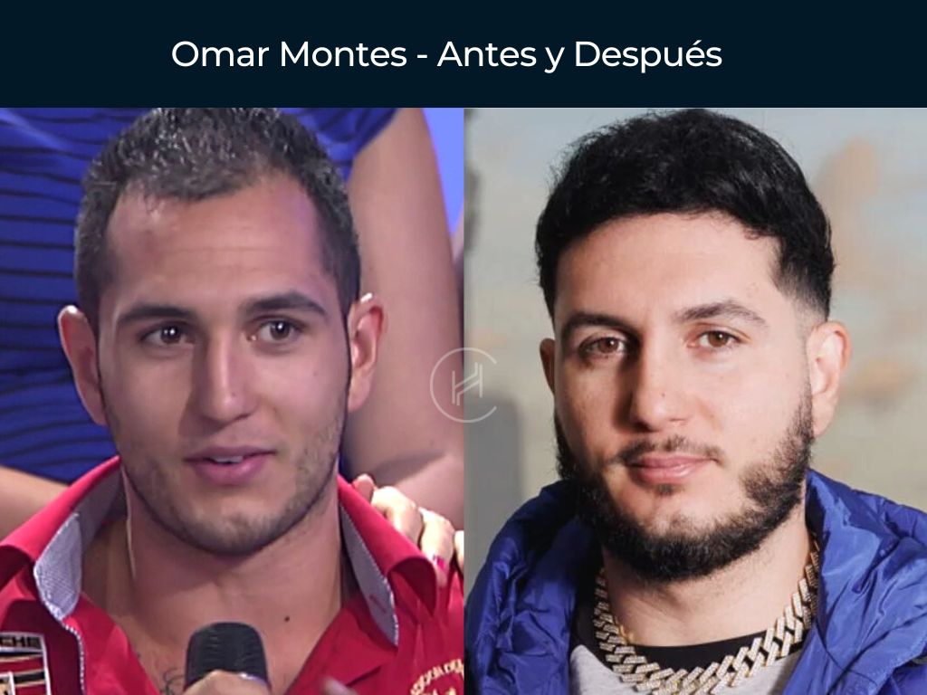 Omar Montes - Antes y Después Injerto Capilar