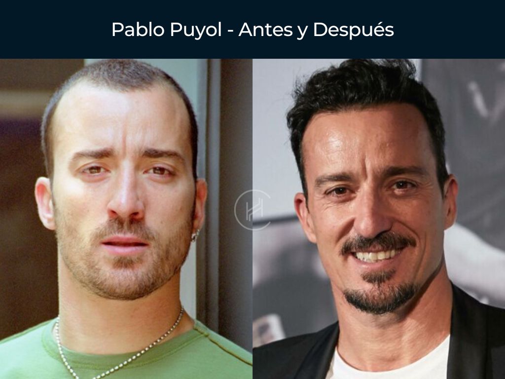 Pablo Puyol - Antes y Después Injerto Capilar