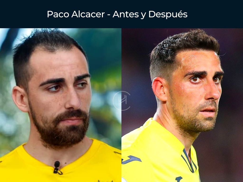 Paco Alcacer - Antes y Después Injerto Capilar