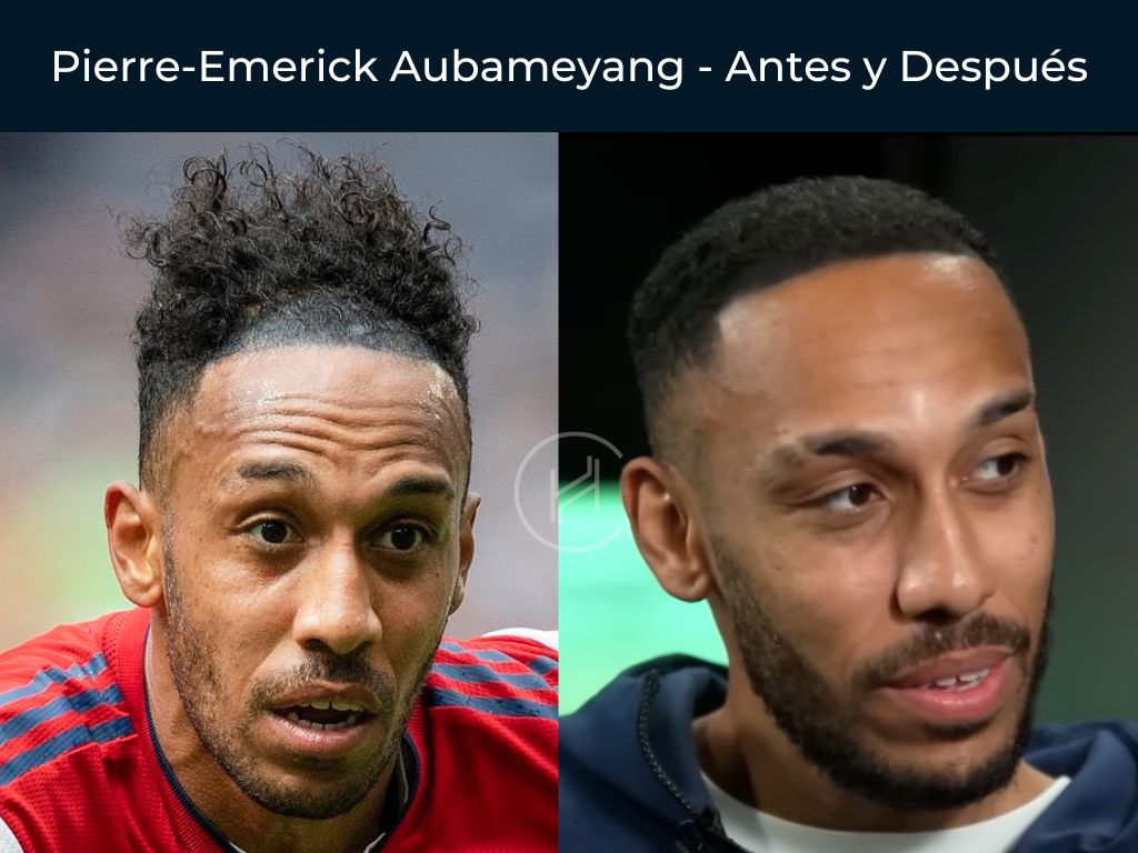 Pierre-Emerick Aubameyang - Antes y Después Injerto Capilar