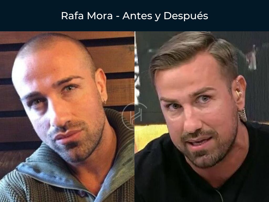 Rafa Mora - Antes y Después Injerto Capilar