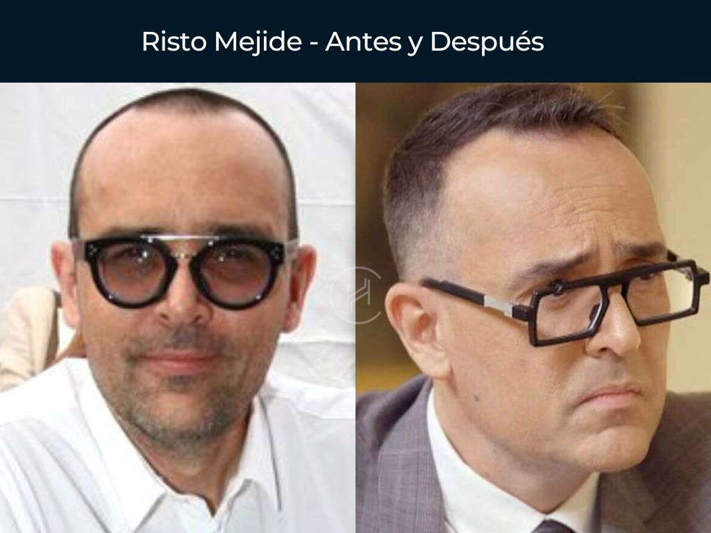 Risto Mejide - Antes y Después Injerto Capilar