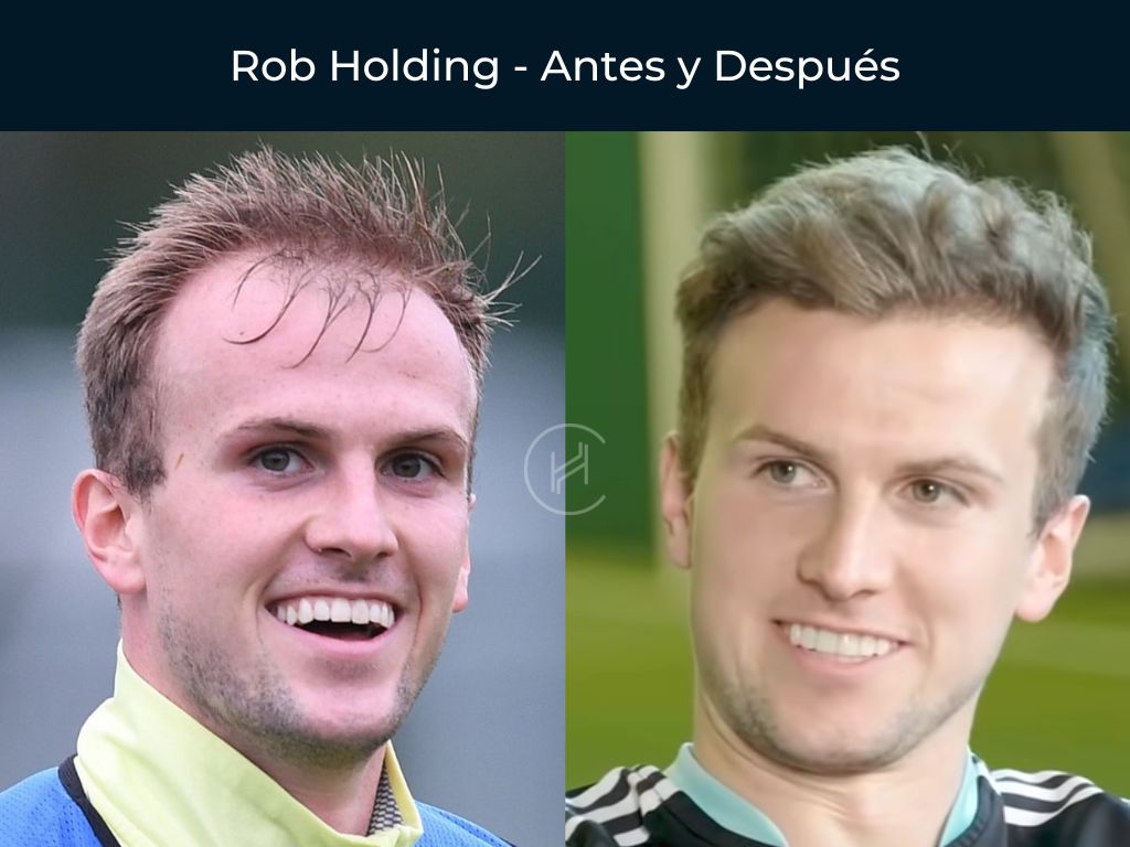 Rob Holding - Antes y Después Injerto Capilar