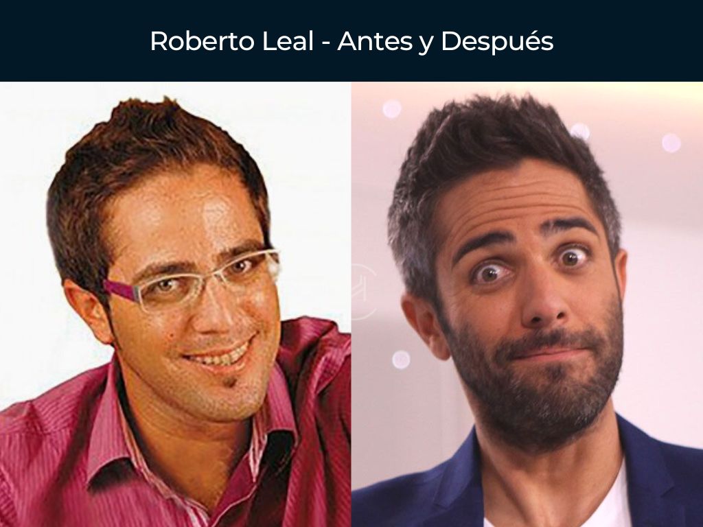Roberto Leal - Antes y Después Injerto Capilar