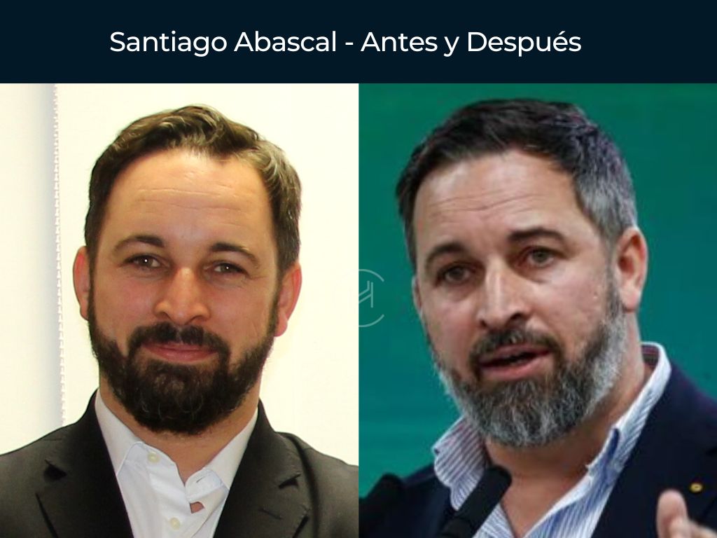 Santiago Abascal - Antes y Después Injerto Capilar