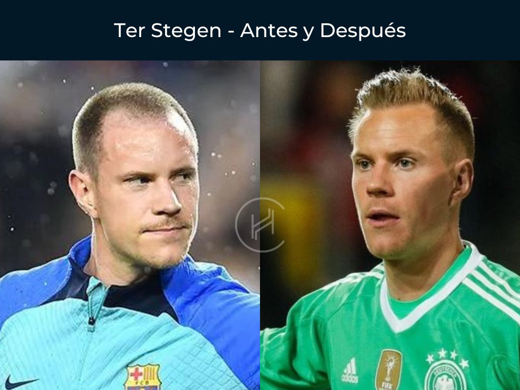 Ter Stegen - Antes y Después Injerto Capilar