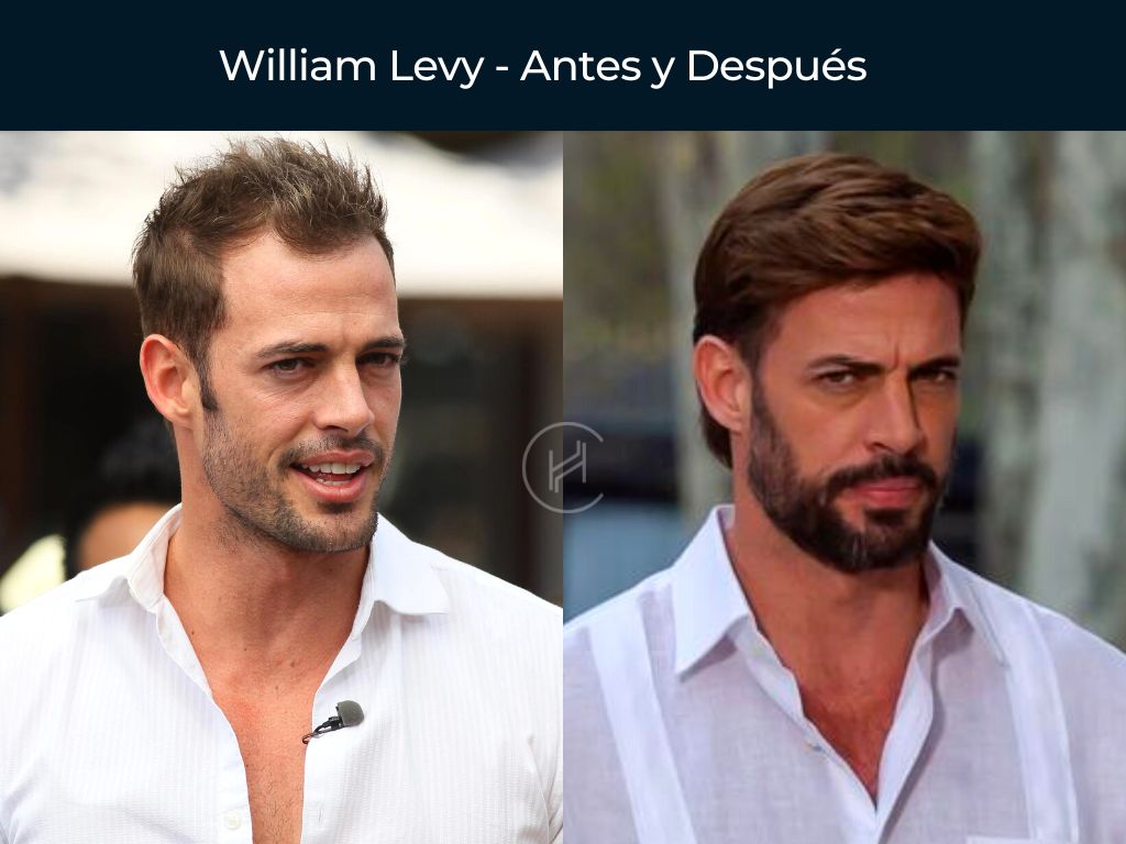 William Levy - Antes y Después Injerto Capilar