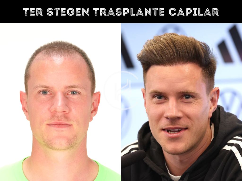 Ter Stegen Trasplante Capilar Antes y Despues