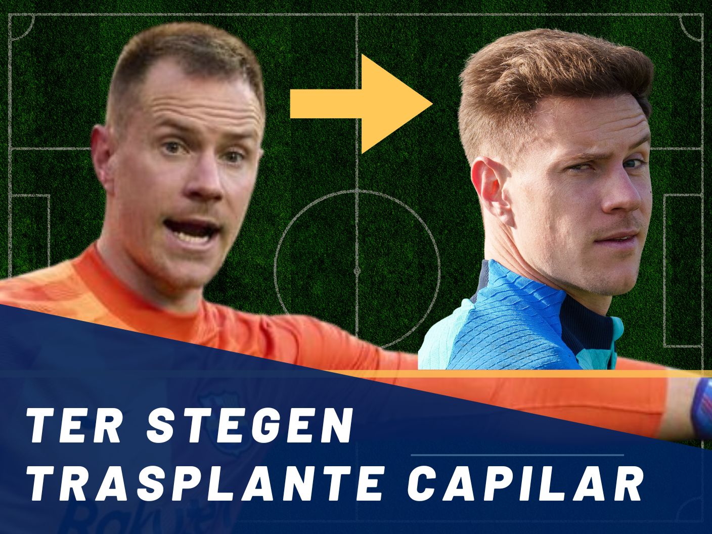 Ter Stegen Trasplante Capilar