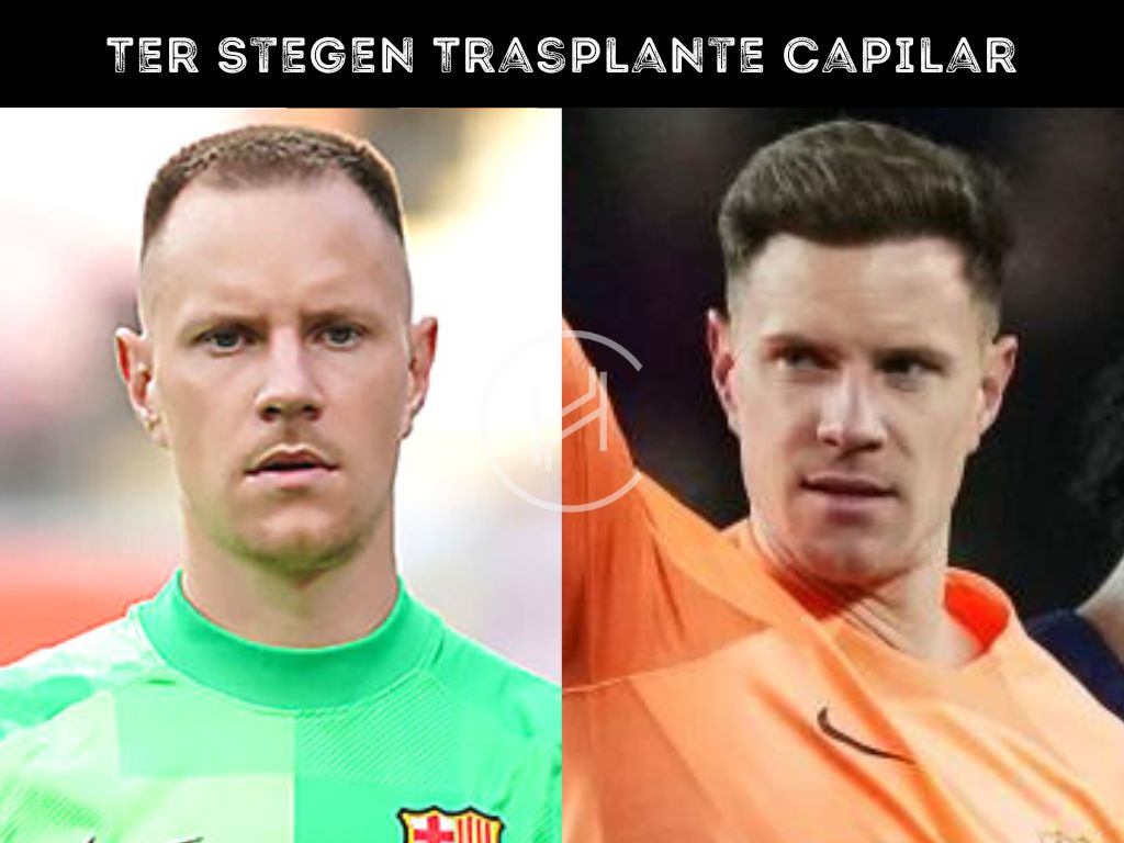 Ter Stegen trasplante de pelo Antes y Despues