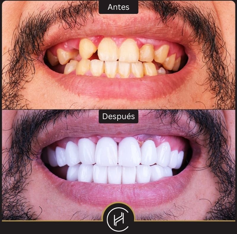 Implantes dentales y una sonrisa de Hollywood antes y después