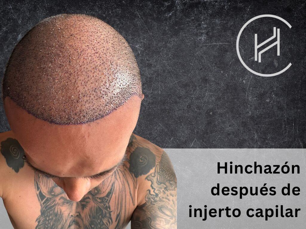 Hinchazón después de injerto capilar