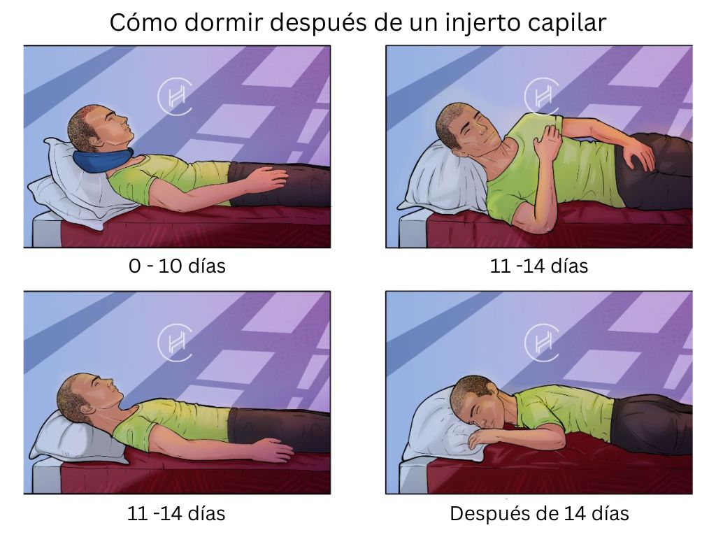 Cómo dormir después de un injerto capilar demostración