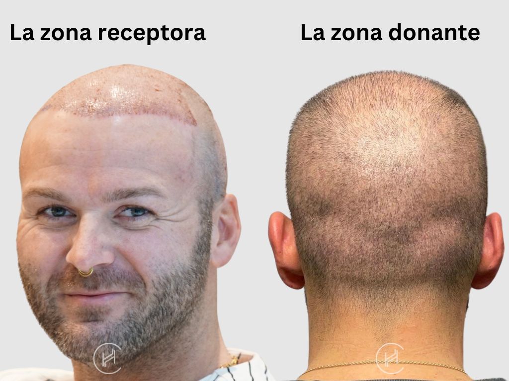 La zona receptora y La zona donante