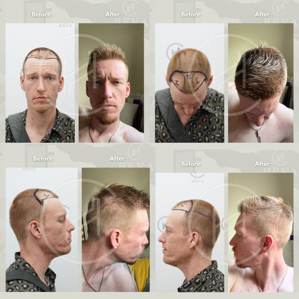 Fue trasplante de cabello antes y después resultado cuatro ángulos