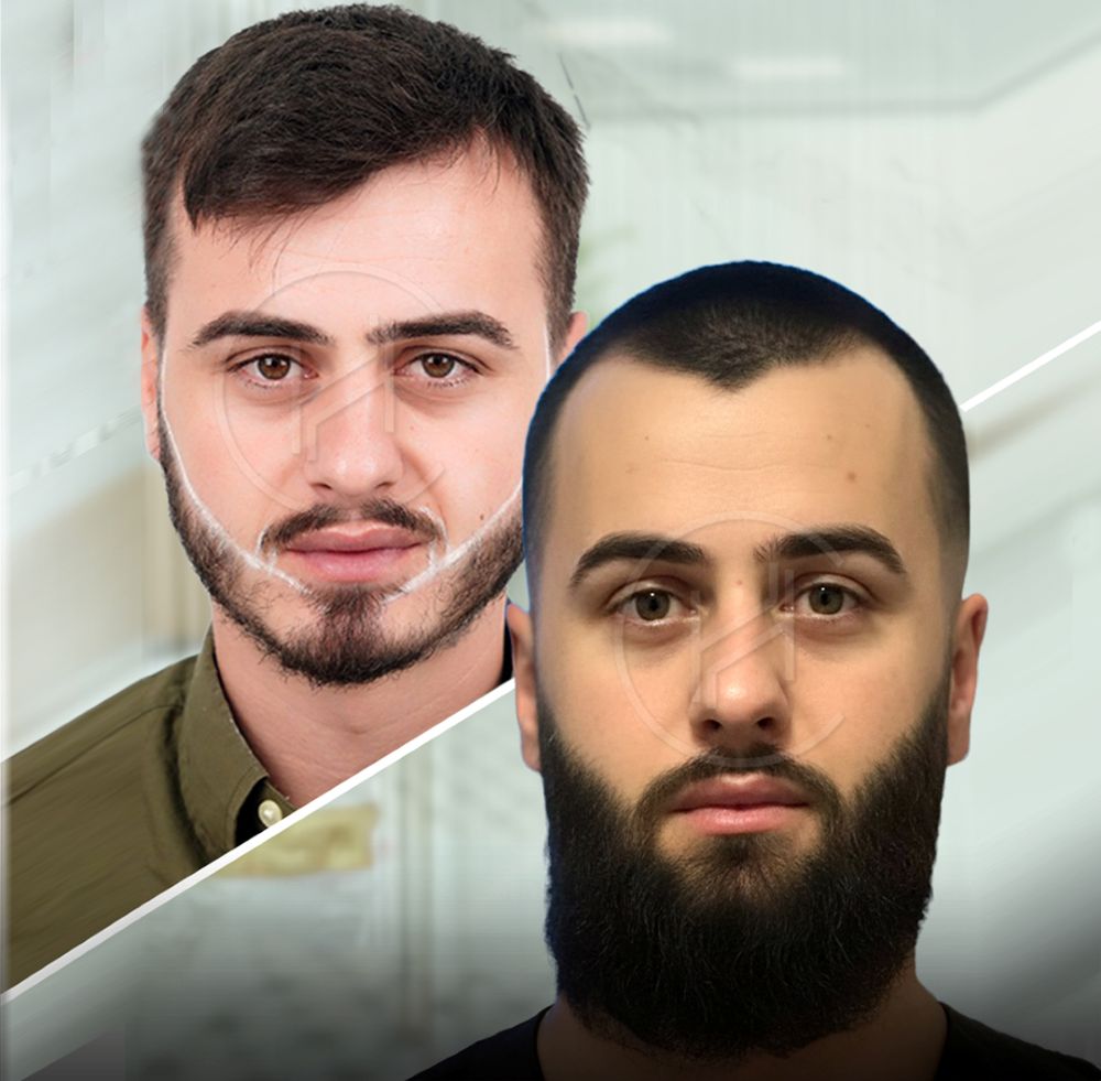 Trasplante de barba antes y después del resultado en Heva Clinic en Estambul Turquía
