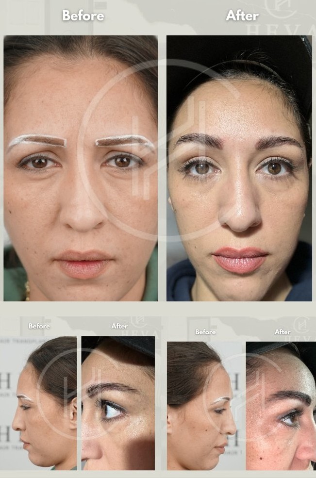 Trasplante de cejas femeninas antes y después del resultado - Heva Clinic Turquia