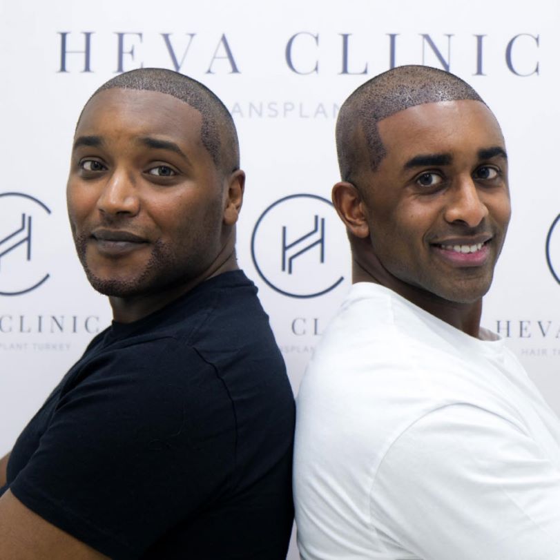 2 patients africains de greffe de cheveux texturés