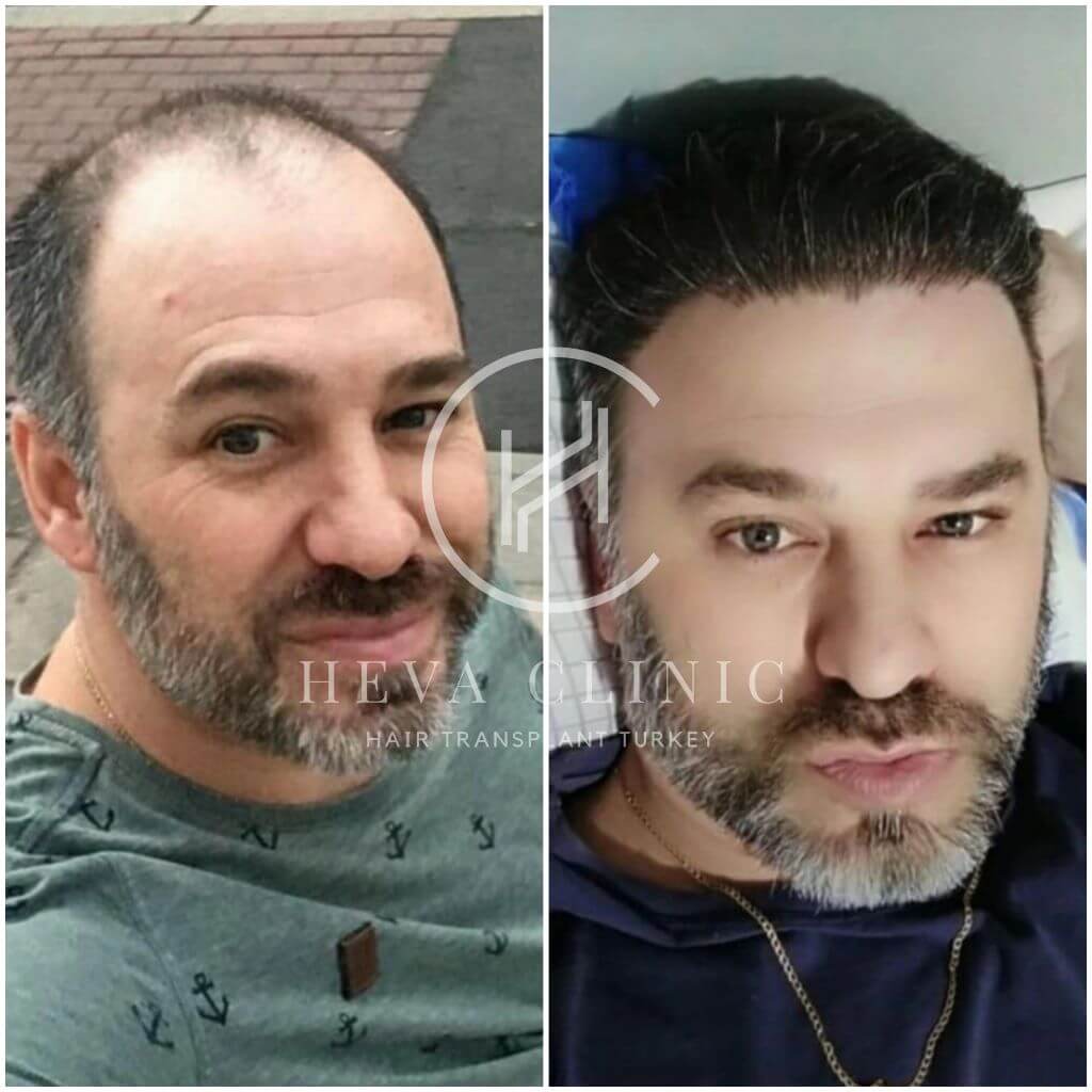 Greffe de cheveux de 4500 greffons avant et après