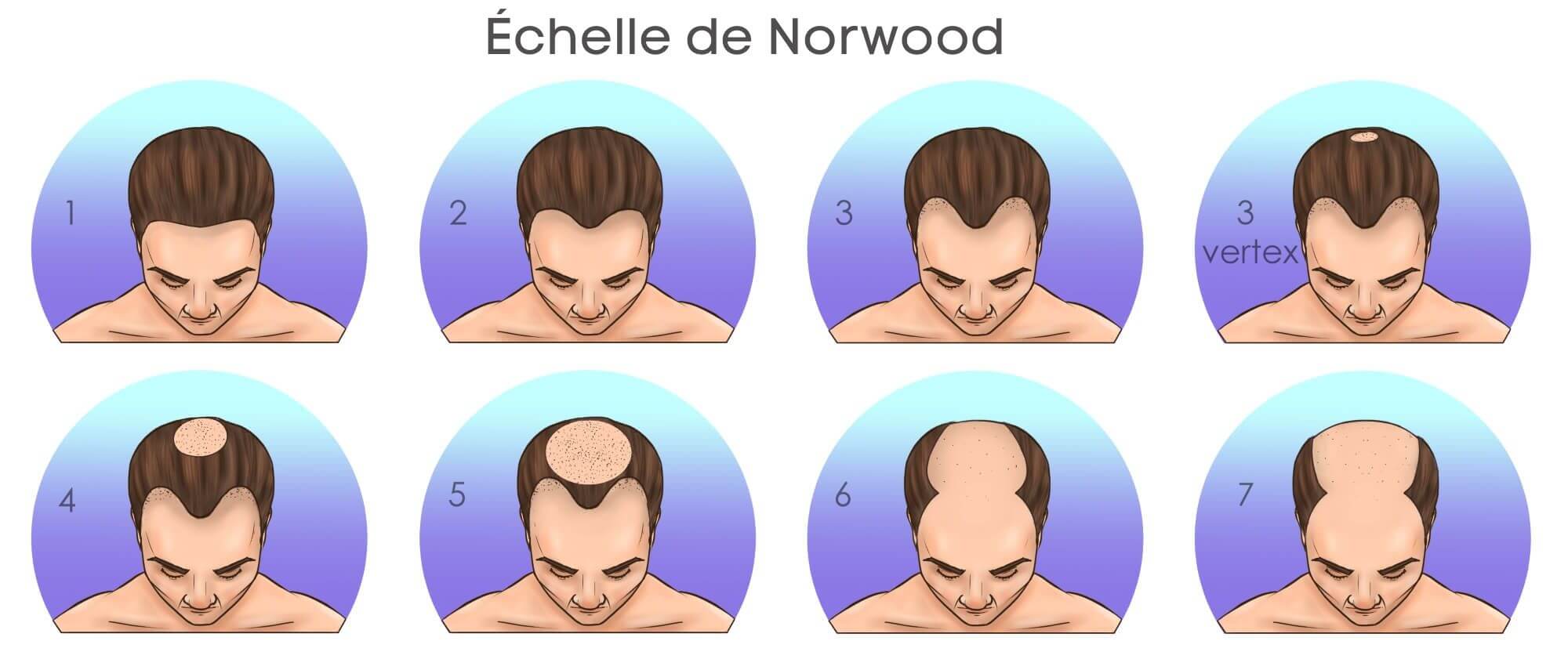 Échelle de norwood de combien de greffons ai-je besoin