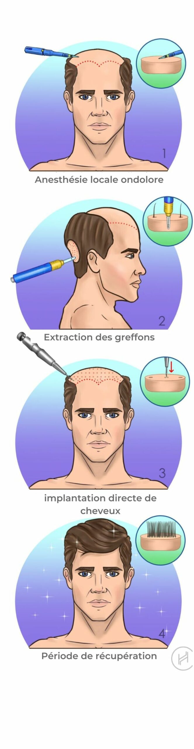 dhi étapes de la greffe de cheveux