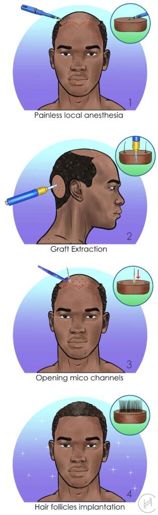 étapes de la procédure de la greffe de cheveux de type afro