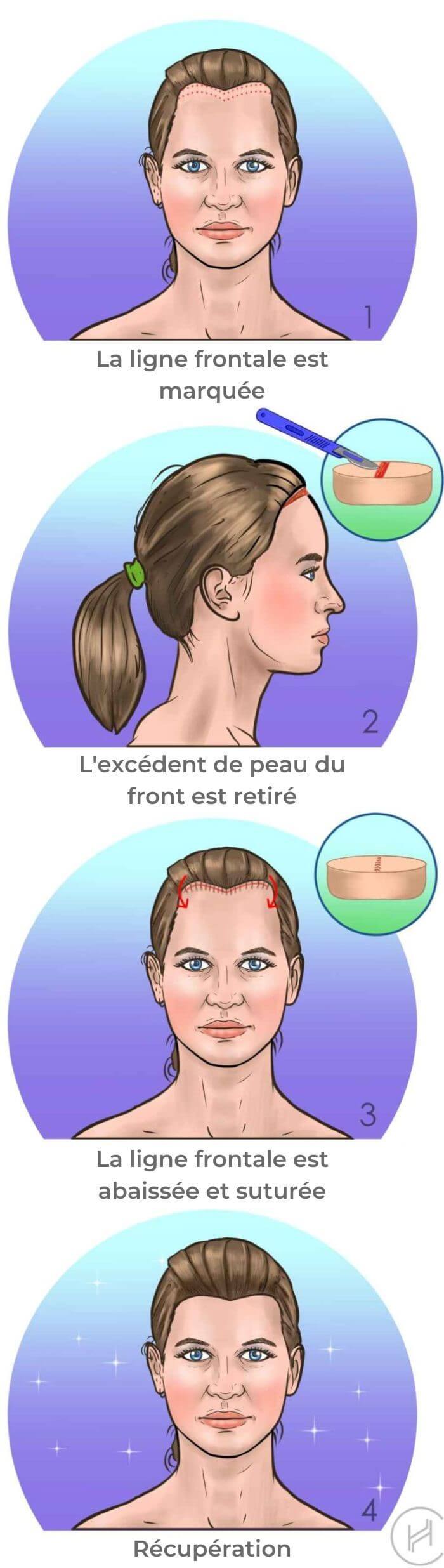 étapes du processus de réduction du front