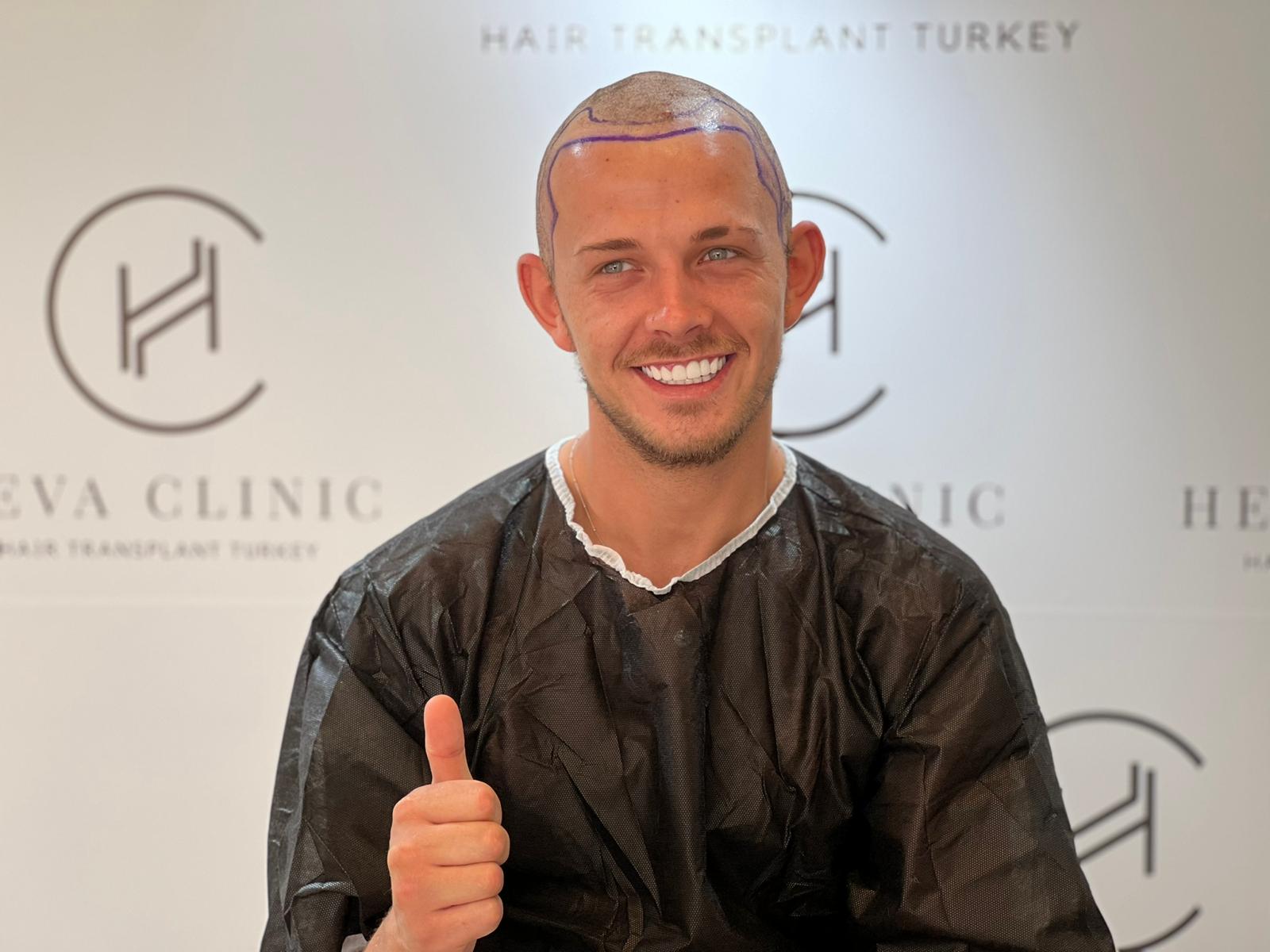 fue greffe de cheveux patient heureux en turquie