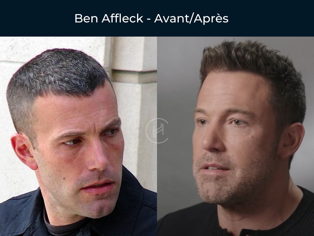 Ben Affleck - Greffe de cheveux avant après