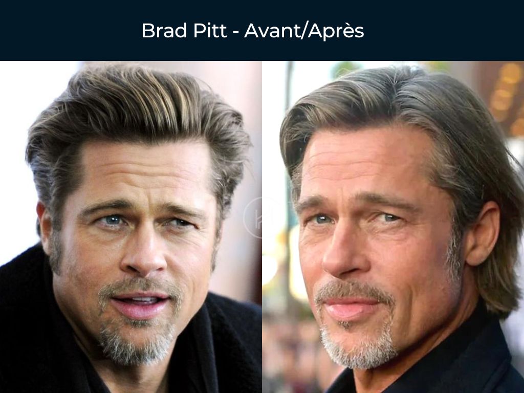 Brad Pitt - Greffe de cheveux avant après Brad Pitt - Greffe de cheveux avant après