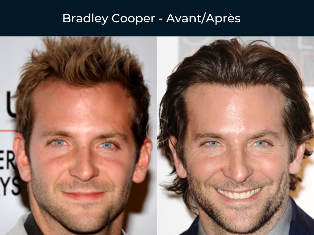 Bradley Cooper - Greffe de cheveux avant après