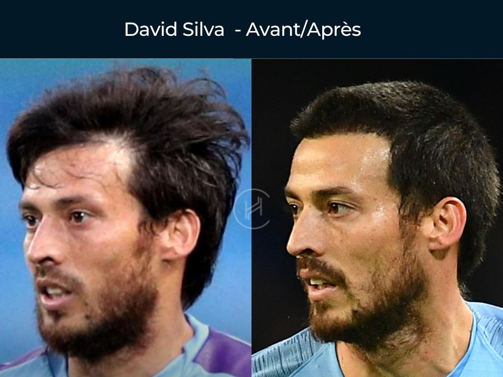 David Silva - Greffe de cheveux avant après
