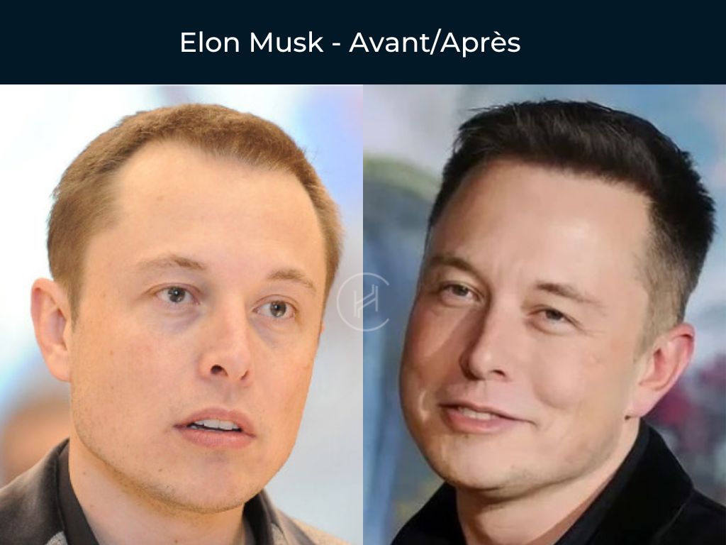 Elon Musk - Greffe de cheveux avant après