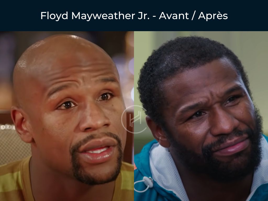 Floyd-Mayweather-Jr-Greffe-de-cheveux-avant-apres-photo