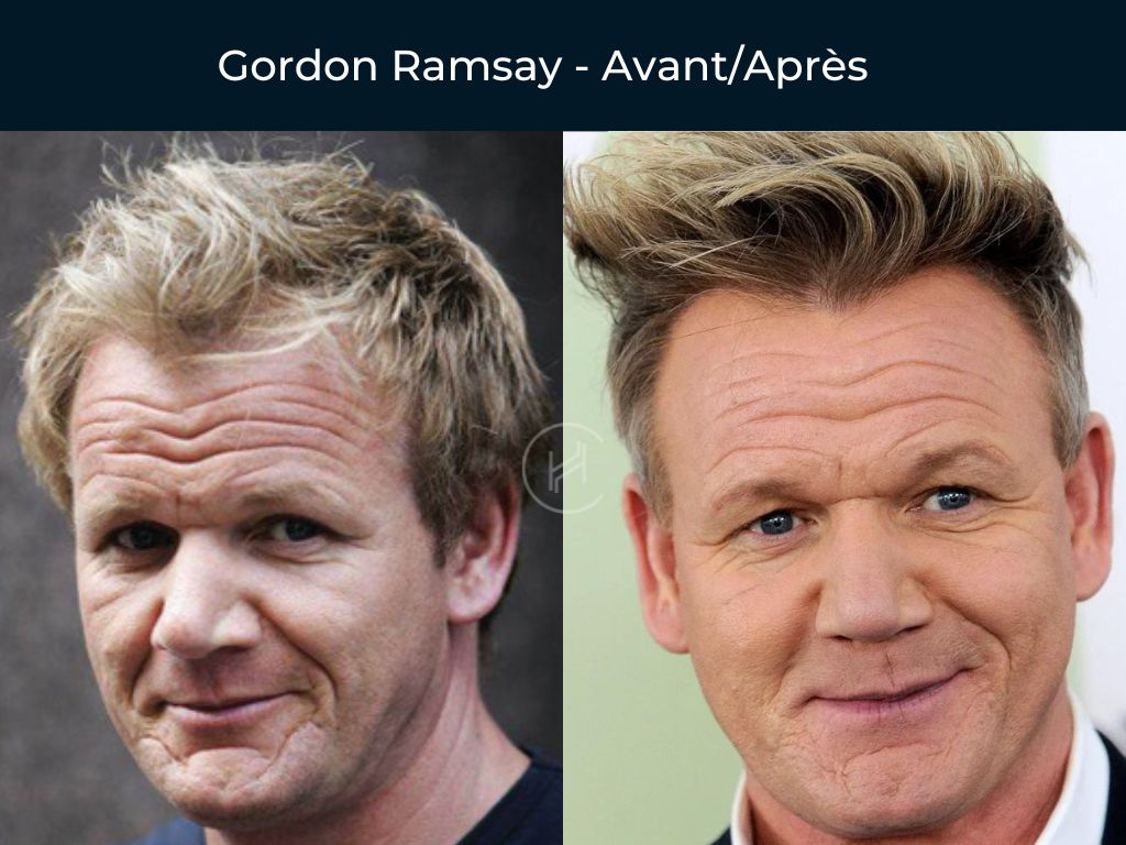 Gordon Ramsay - Greffe de cheveux avant après