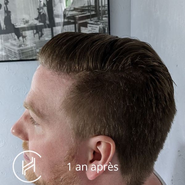 Greffe de cheveux 1 an après (3)