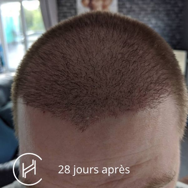 Greffe de cheveux 28 jours après