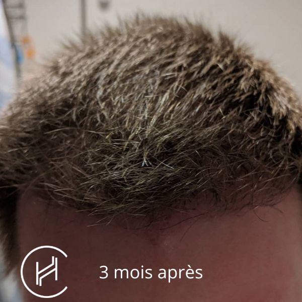 Greffe de cheveux 3 mois après